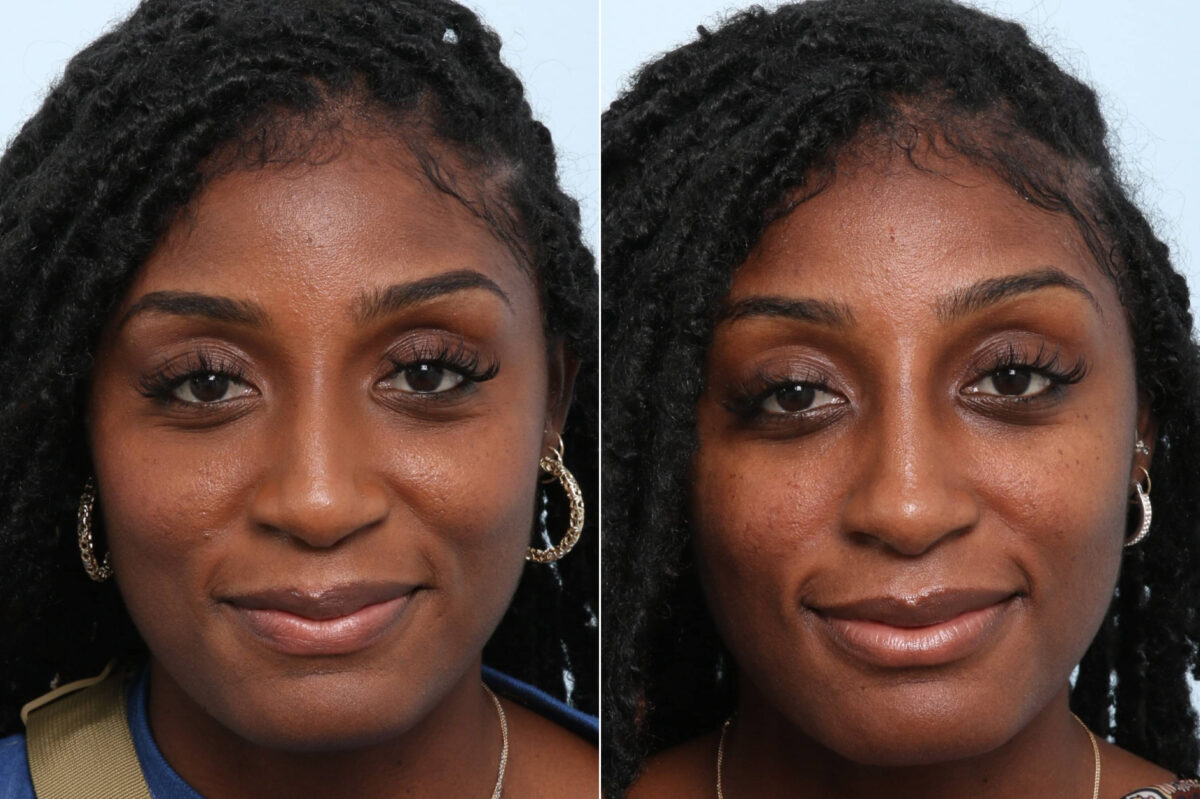 Non-Surgical Rhinoplasty before and after photos in Houston, TX, Patient 58675