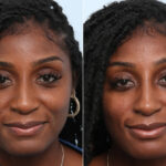 Non-Surgical Rhinoplasty before and after photos in Houston, TX, Patient 58675