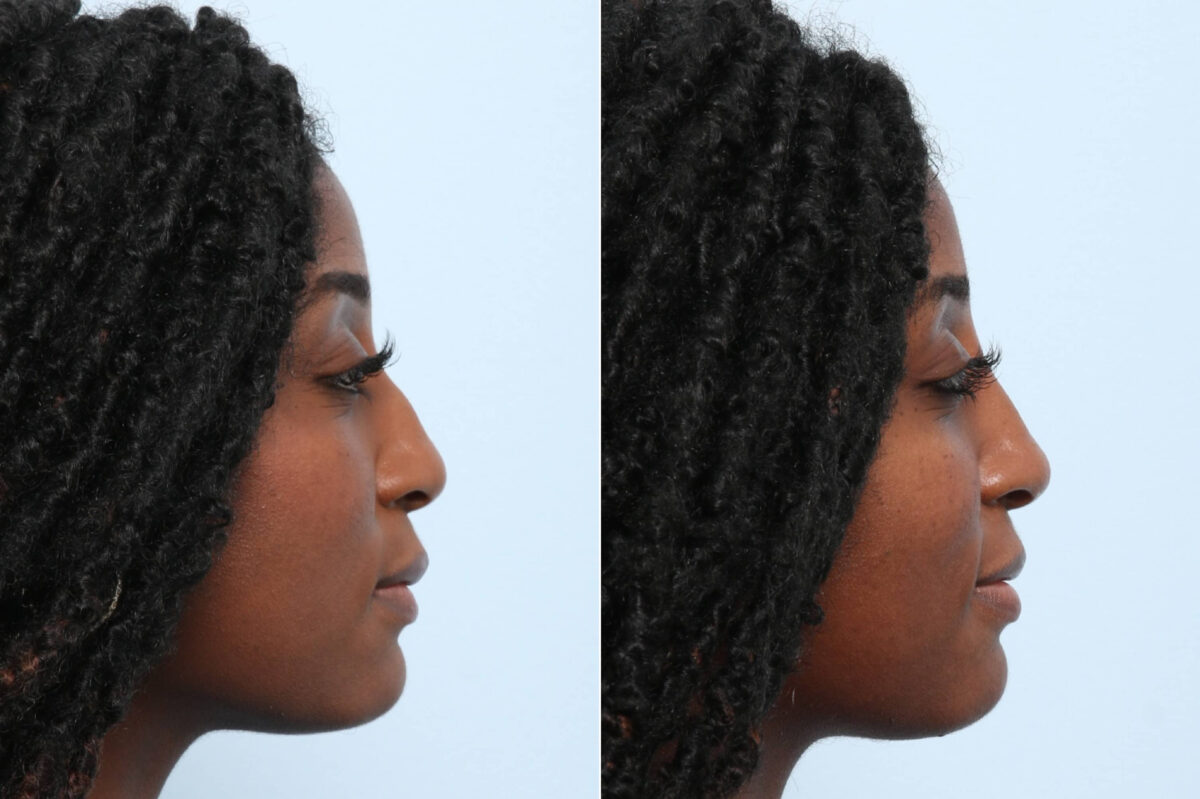 Non-Surgical Rhinoplasty before and after photos in Houston, TX, Patient 58675