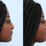 Non-Surgical Rhinoplasty before and after photos in Houston, TX, Patient 58675