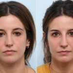 Non-Surgical Rhinoplasty before and after photos in Houston, TX, Patient 58694