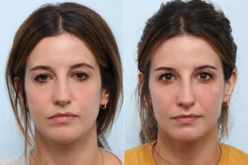 Non-Surgical Rhinoplasty before and after photos in Houston, TX, Patient 58694