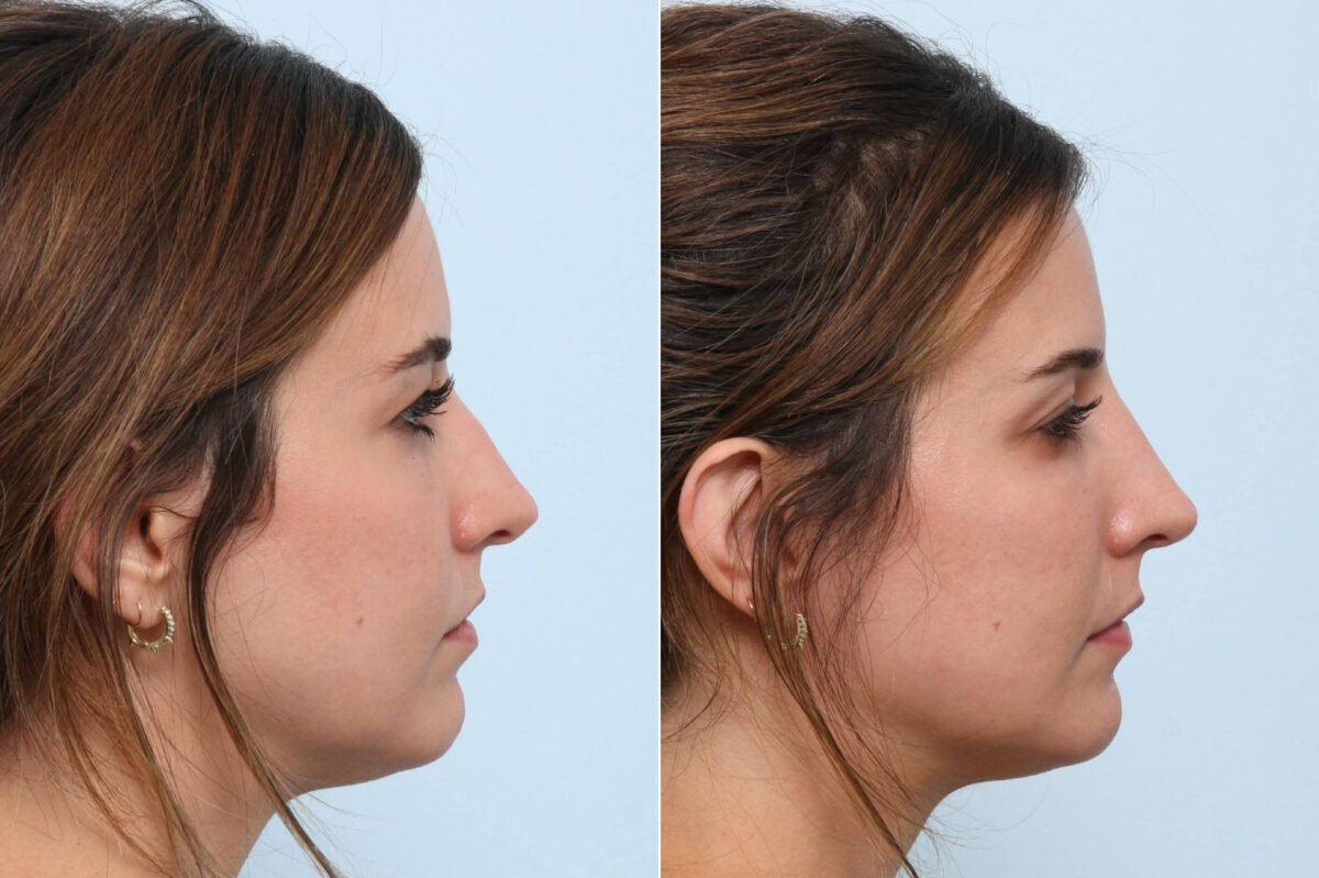 Non-Surgical Rhinoplasty before and after photos in Houston, TX, Patient 58694