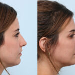 Non-Surgical Rhinoplasty before and after photos in Houston, TX, Patient 58694