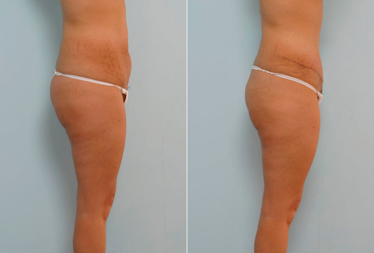 Abdominoplasty before and after photos in Houston, TX, Patient 24261