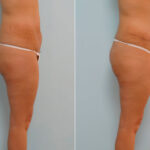 Abdominoplasty before and after photos in Houston, TX, Patient 24261