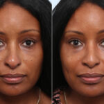 Non-Surgical Rhinoplasty before and after photos in Houston, TX, Patient 58707