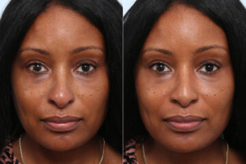 Non-Surgical Rhinoplasty before and after photos in Houston, TX, Patient 58707