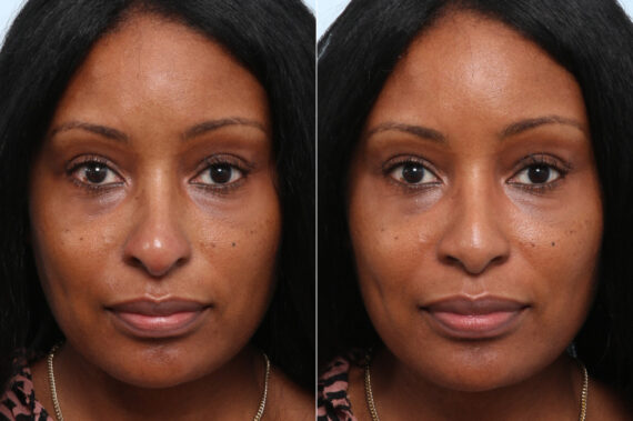 Non-Surgical Rhinoplasty before and after photos in Houston, TX, Patient 58707