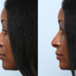 Non-Surgical Rhinoplasty before and after photos in Houston, TX, Patient 58707
