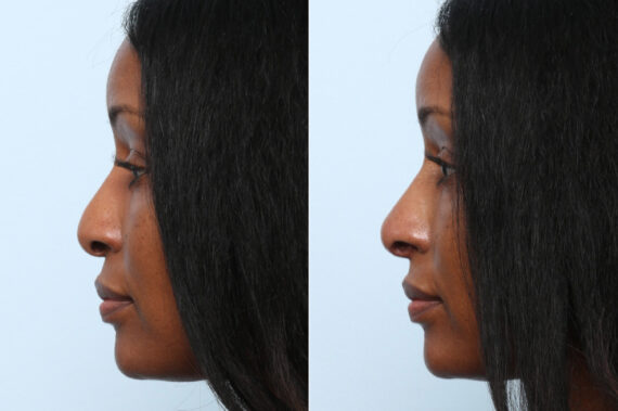 Non-Surgical Rhinoplasty before and after photos in Houston, TX, Patient 58707