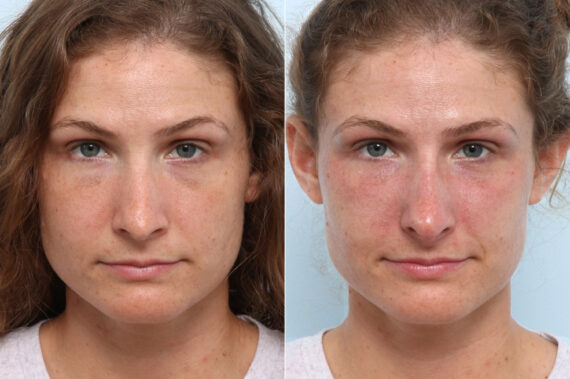 Non-Surgical Rhinoplasty before and after photos in Houston, TX