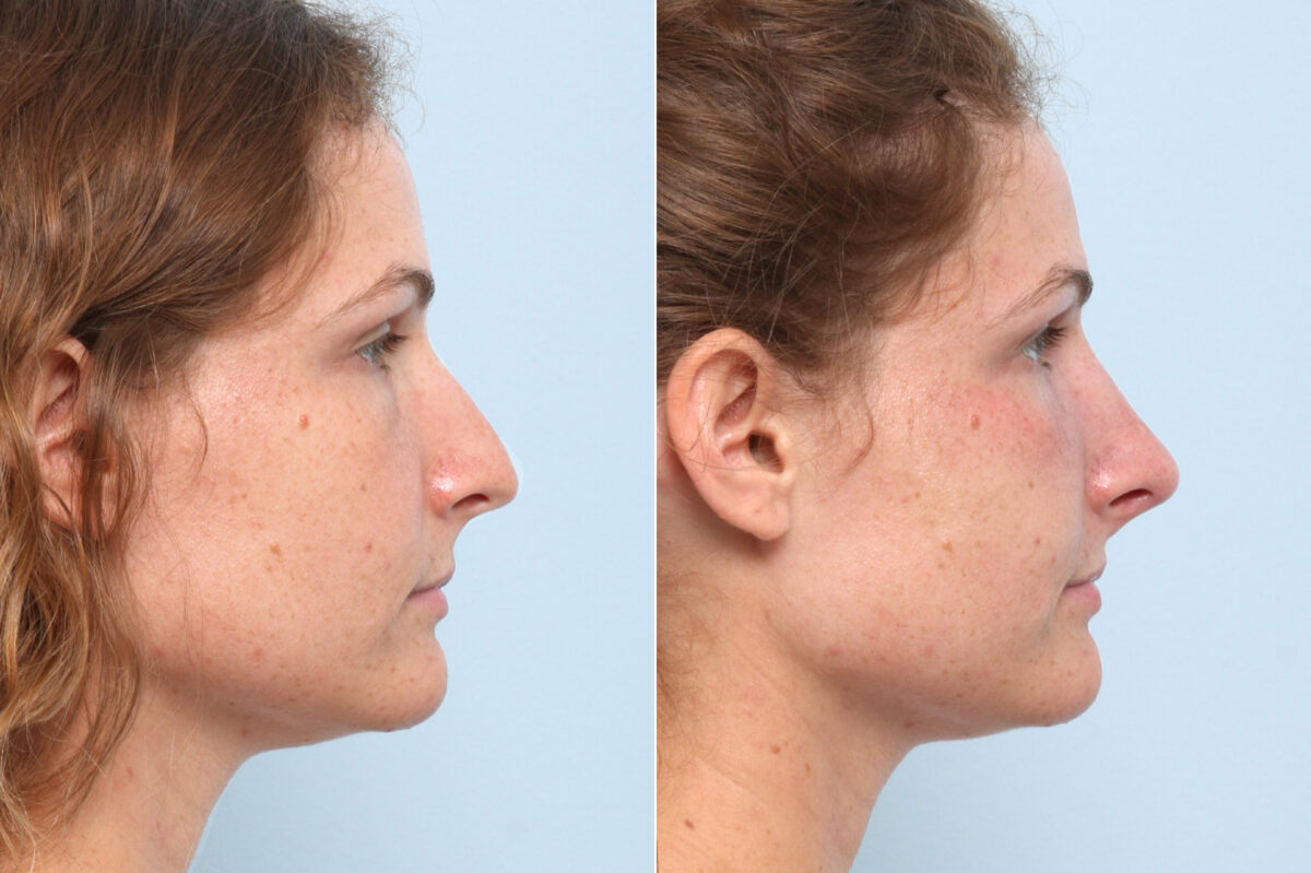 Non-Surgical Rhinoplasty before and after photos in Houston, TX, Patient 58718