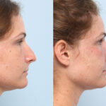 Non-Surgical Rhinoplasty before and after photos in Houston, TX, Patient 58718