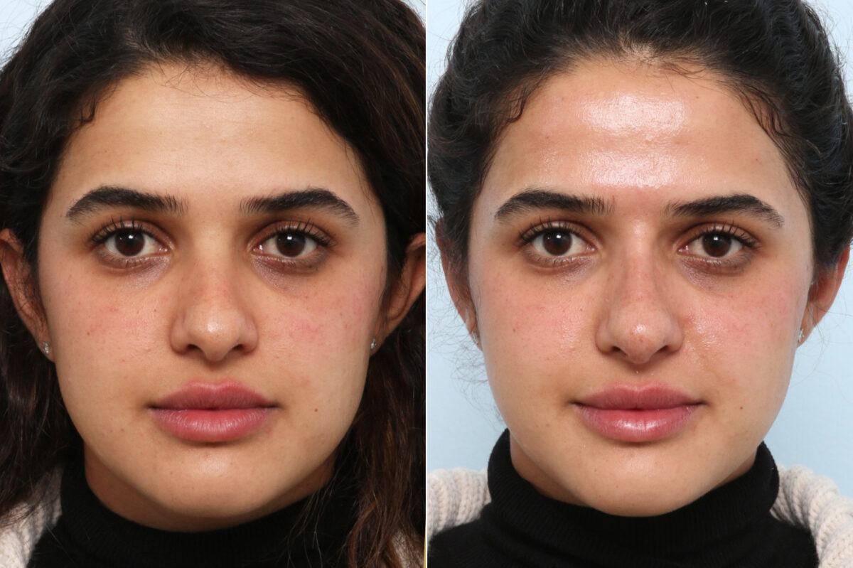 Non-Surgical Rhinoplasty before and after photos in Houston, TX, Patient 58821