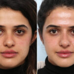 Non-Surgical Rhinoplasty before and after photos in Houston, TX, Patient 58821
