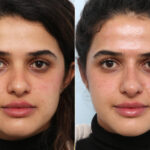 Non-Surgical Rhinoplasty before and after photos in Houston, TX, Patient 58821