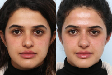 Non-Surgical Rhinoplasty before and after photos in Houston, TX, Patient 58821