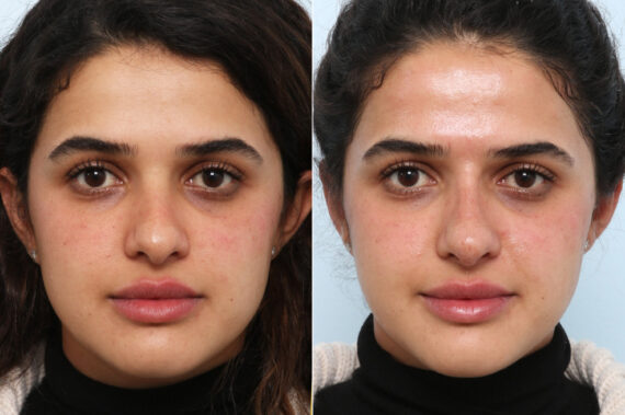 Non-Surgical Rhinoplasty before and after photos in Houston, TX