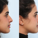 Non-Surgical Rhinoplasty before and after photos in Houston, TX, Patient 58821