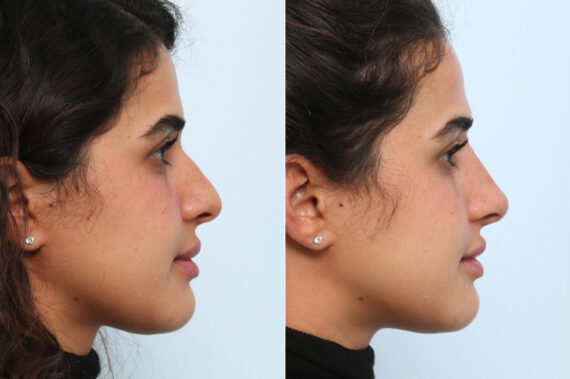 Non-Surgical Rhinoplasty before and after photos in Houston, TX, Patient 58821