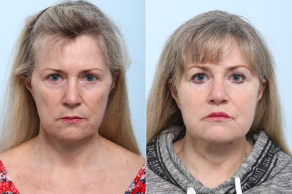 Lip Shortening Surgery before and after photos in Houston, TX, Patient 58839