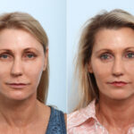 Lip Shortening Surgery before and after photos in Houston, TX, Patient 58840