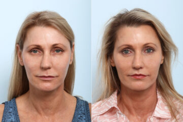 Lip Shortening Surgery before and after photos in Houston, TX, Patient 58840