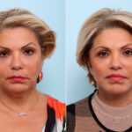 Lip Shortening Surgery before and after photos in Houston, TX, Patient 58842