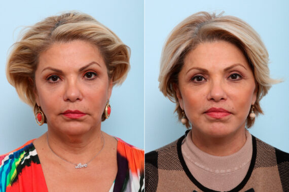 Lip Shortening Surgery before and after photos in Houston, TX, Patient 58842