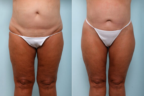 Body Lift before and after photos in Houston, TX, Patient 59027