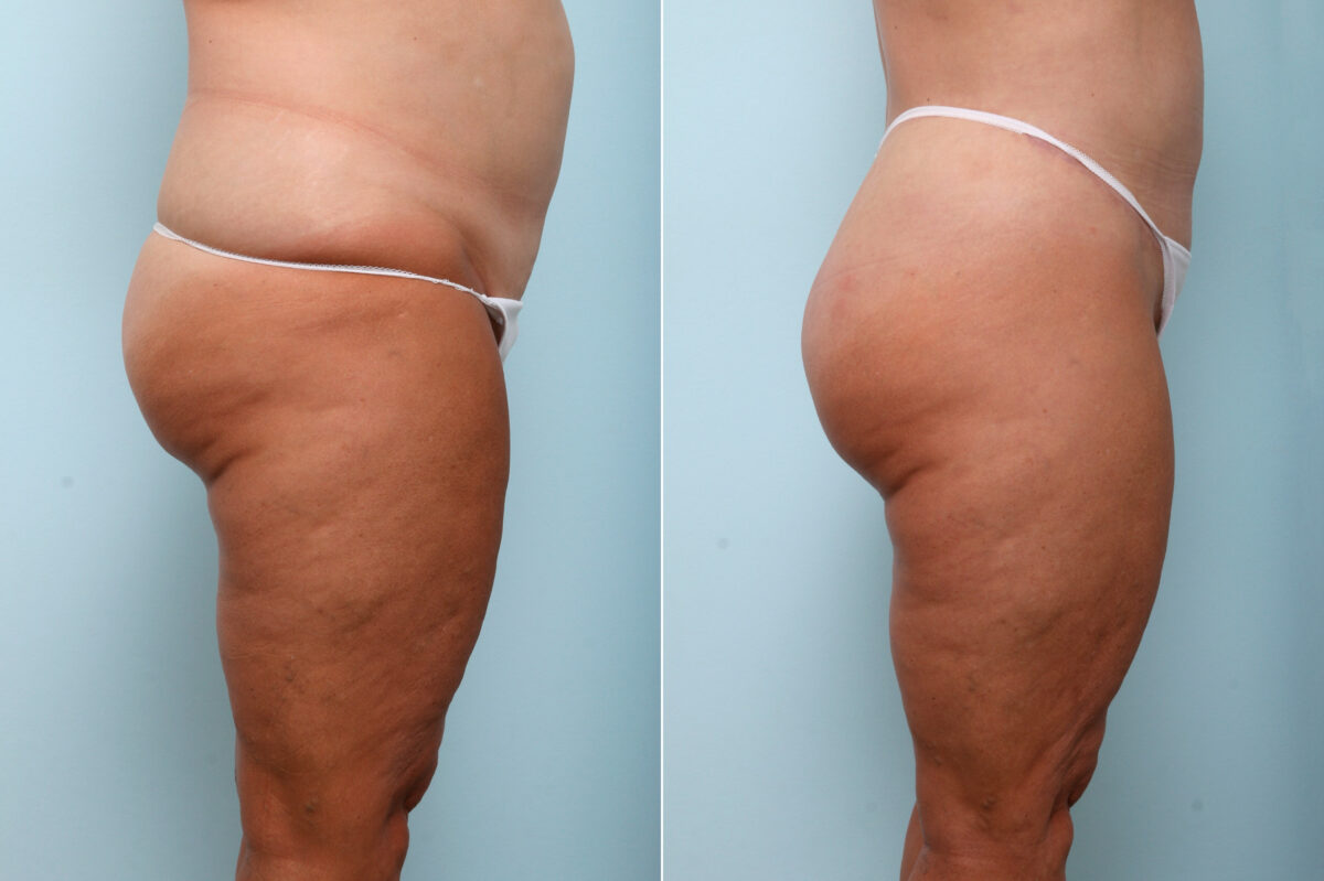 Body Lift before and after photos in Houston, TX, Patient 59027