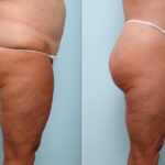 Body Lift before and after photos in Houston, TX, Patient 59027