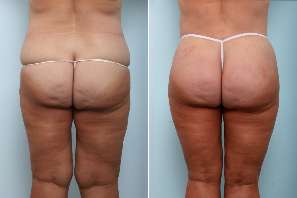 Body Lift before and after photos in Houston, TX, Patient 59027