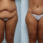 Body Lift before and after photos in Houston, TX, Patient 59137