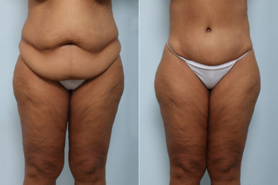 Body Lift before and after photos in Houston, TX, Patient 59137