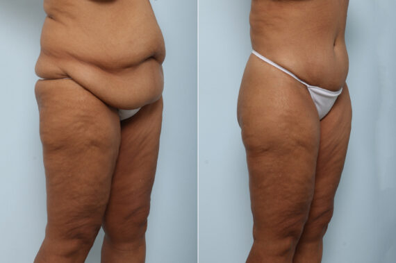 Body Lift before and after photos in Houston, TX, Patient 59137