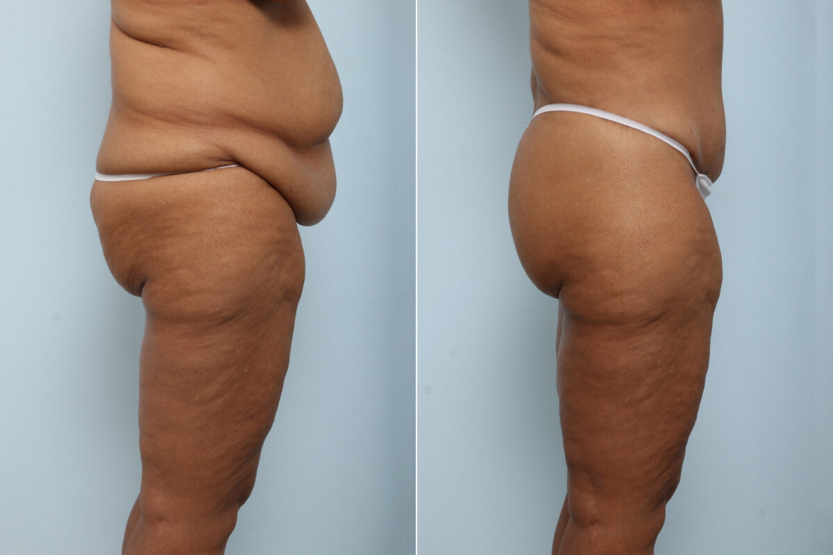 Body Lift before and after photos in Houston, TX, Patient 59137