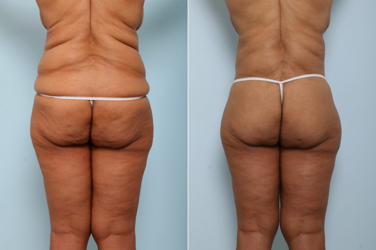 Body Lift before and after photos in Houston, TX, Patient 59137