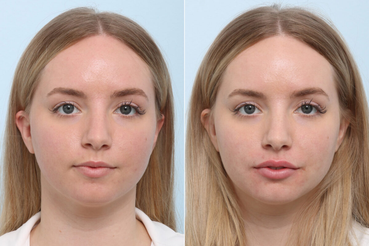 Lip Augmentation before and after photos in Houston, TX, Patient 59166