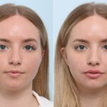 Lip Augmentation before and after photos in Houston, TX, Patient 59166