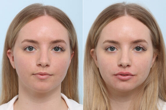 Lip Augmentation before and after photos in Houston, TX, Patient 59166