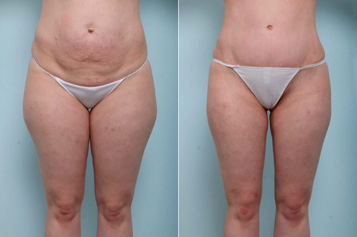 Abdominoplasty before and after photos in Houston, TX, Patient 59222