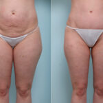 Abdominoplasty before and after photos in Houston, TX, Patient 59222