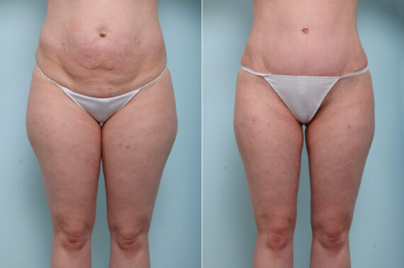Tummy Tuck/Abdominoplasty before and after photos in Houston, TX, Patient 59222