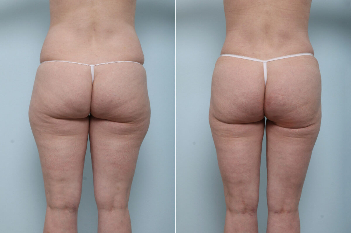 Abdominoplasty before and after photos in Houston, TX, Patient 59222