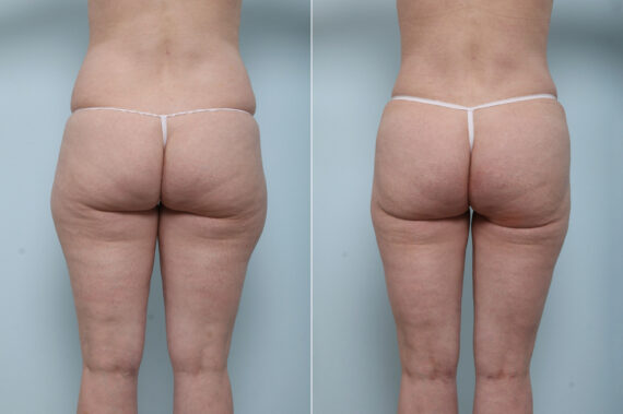 Tummy Tuck/Abdominoplasty before and after photos in Houston, TX, Patient 59222