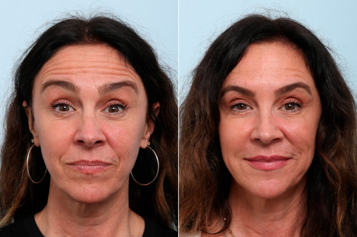 Botox® Cosmetic before and after photos in Houston, TX, Patient 59236