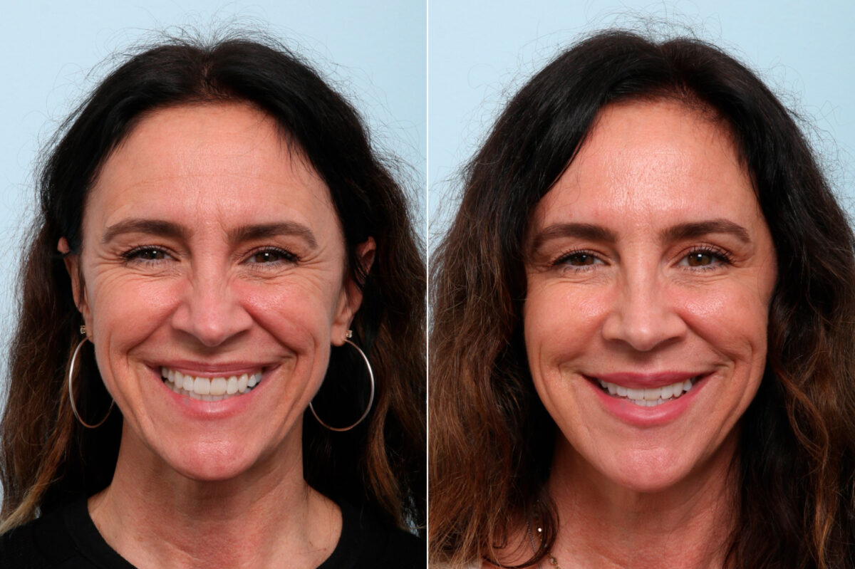 Xeomin / Botox® Cosmetic before and after photos in Houston, TX, Patient 59236