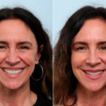 Botox® Cosmetic before and after photos in Houston, TX, Patient 59236